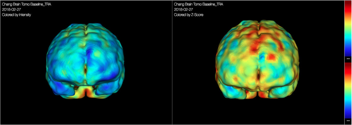 FDA Clears CereMetrix's Neuroimaging Analytics and Clinical